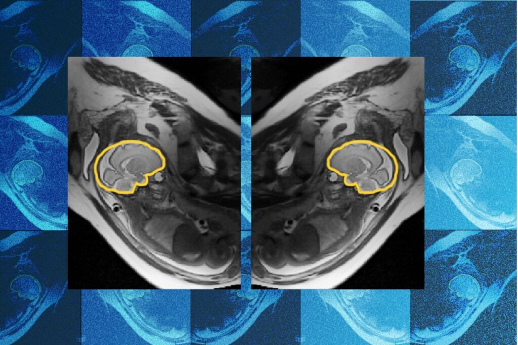 AI uczy się symetrii, by poprawić prenatalną diagnostykę mózgu