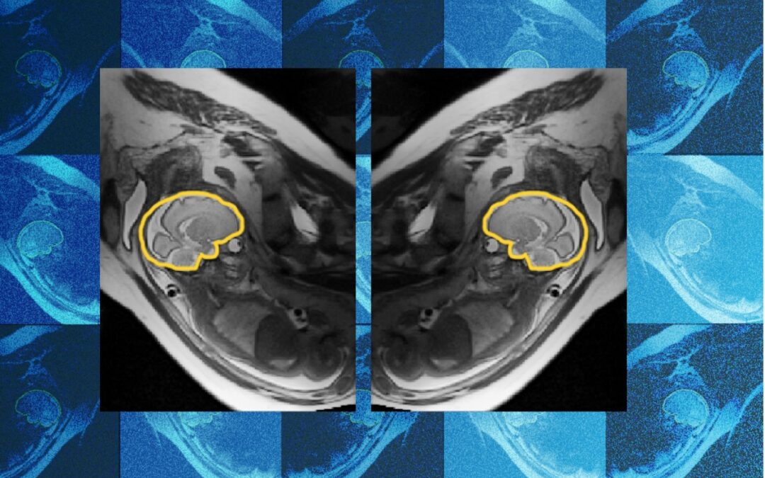 AI uczy się symetrii, by poprawić prenatalną diagnostykę mózgu